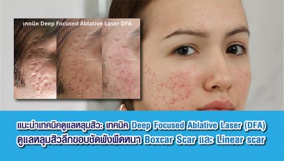 แนะนำเทคนิคดูแลหลุมสิว: เทคนิค Deep Focused Ablative Laser (DFA) ดูแลหลุมสิวลึกขอบชัดพังผืดหนา Boxcar Scar และ Linear scar